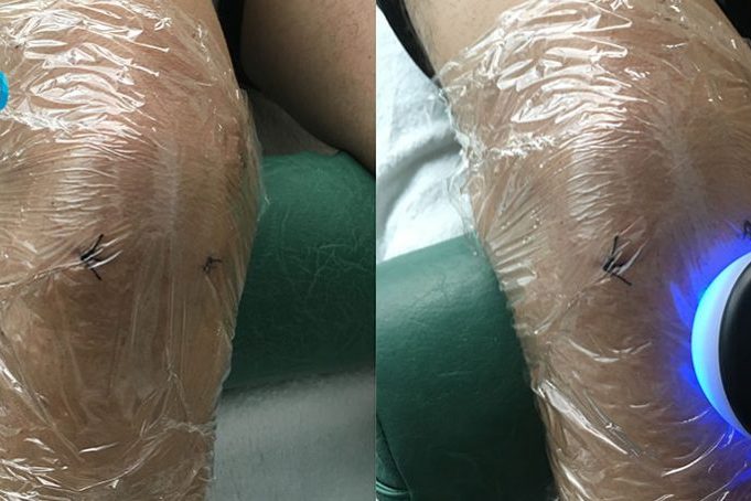 diatermia-abd-heridas-abiertas