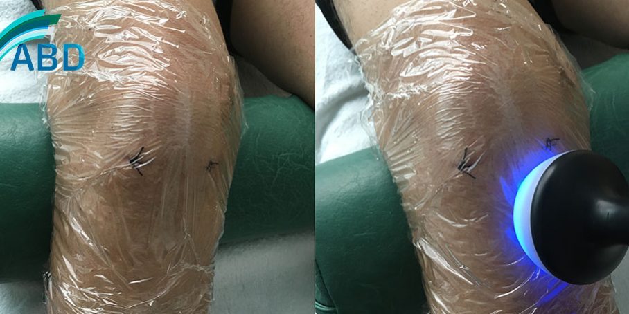 diatermia-abd-heridas-abiertas