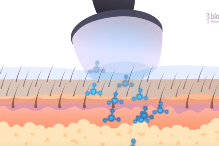 video-diatermia-dielectrica